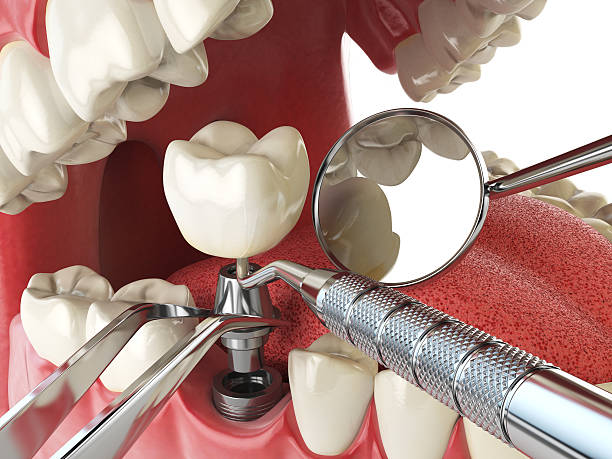 Best Root Canal Emergency Dentist  in Naples Manor, FL